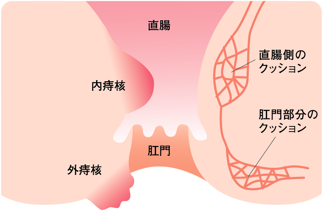 痔核（いぼ痔）とは