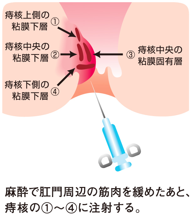 ジオン注射療法の内容