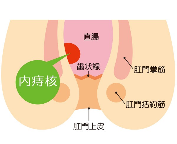 いぼ痔「内痔核」の主な症状