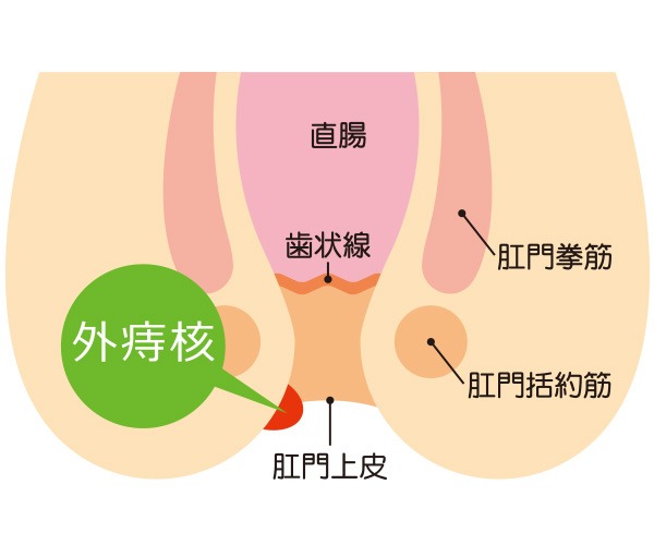 いぼ痔「外痔核」の主な症状